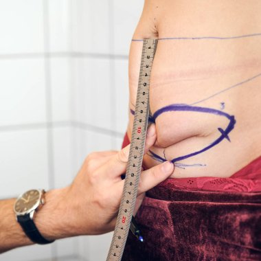 Estetik ameliyattan önce kadın karnını cetvelle ölçen estetik cerrahın elini kapat. Erkek doktor, kadın hastanın göbek yağlarını kontrol ediyor. Abdominoplasti ve ameliyat hazırlığı kavramı.