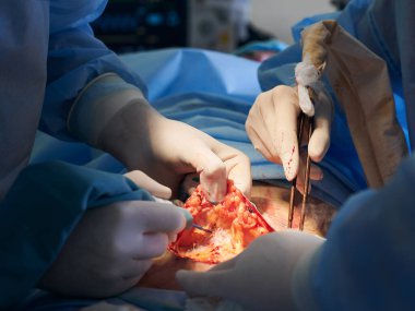 Estetik cerrah ve asistanlar estetik ameliyat yapıyorlar ve hastanedeki ameliyathanede tıbbi aletler kullanıyorlar. Tıp, abdominoplasti ve estetik cerrahi kavramı.