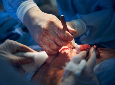 Steril eldivenlerle doktor ellerine yakın karın ameliyatı yaparken neşterle fazla deri kesme, karın estetiği sırasında ekstra yağ ve deriyi hastanın karnından çıkarma..