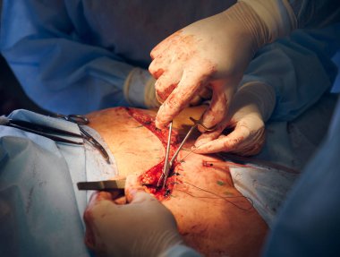 Estetik ameliyat yaparken tıbbi aletler kullanarak steril eldiven takan tıp çalışanlarını kapatın. Cerrah ve asistan karın estetiği yapıyor. Abdominoplasti kavramı.