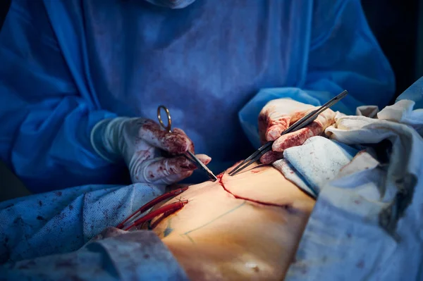 수술을 의사들이 기구를 사용하여 감쌌다 의사가 수술실에서 수술을 수술및지 — 스톡 사진