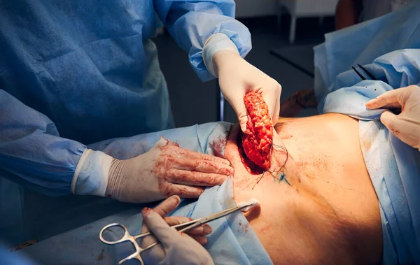 Närbild Läkare Sterila Handskar Som Utför Magkirurgi Operationssalen Plastkirurg Bort — Stockfoto