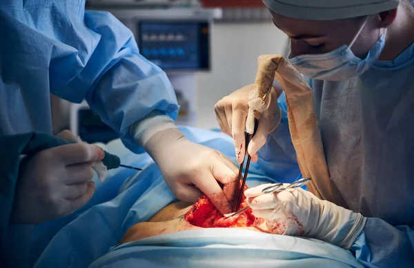 Close Doctors Performing Tummy Tuck Surgery Operating Room Plastic Surgeon — Stock Photo, Image