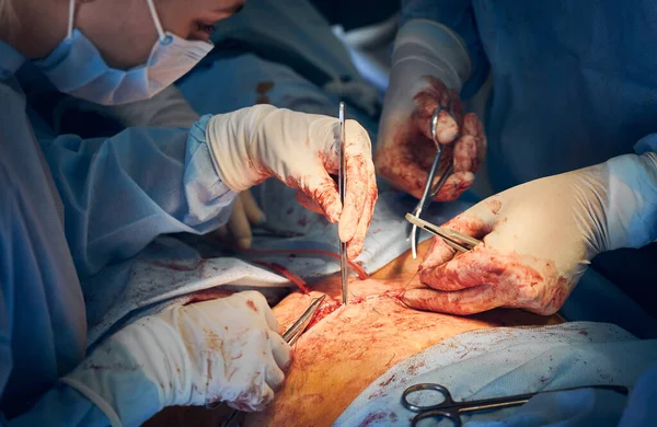 Närbild Läkare Och Assistent Handskar Placera Suturer Efter Magen Tuck — Stockfoto