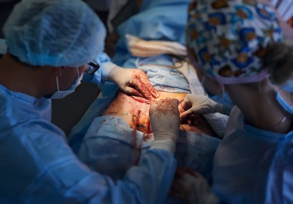 Close up of male surgeon and female assistant stitching up wound after tummy tuck surgery. Focus on doctors hands conducting abdominal plastic surgery in operating room. Concept of abdominoplasty.