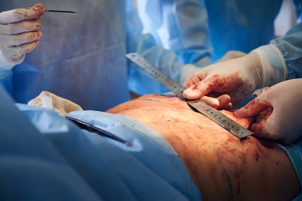 Närbild Kirurg Händer Sterila Handskar Som Mäter Patientens Mage Med — Stockfoto