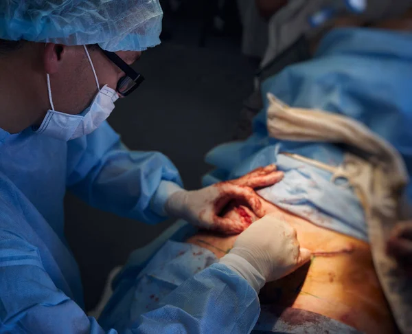 Close up of male surgeon placing sutures after tummy tuck surgery. Doctor in medical face mask performing abdominal plastic surgery in operating room. Concept of abdominoplasty and cosmetic surgery.