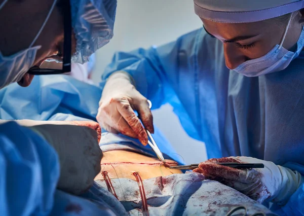 Close Surgical Team Sterile Gloves Stitching Wound Tummy Tuck Surgery — Stock Photo, Image