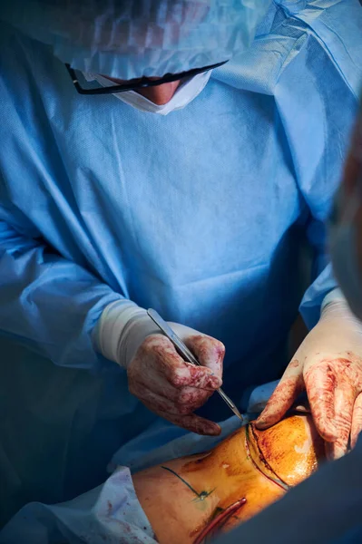 Lekarz Krojący Brzuch Skalpelem Podczas Operacji Plastycznej Brzucha Sali Operacyjnej — Zdjęcie stockowe