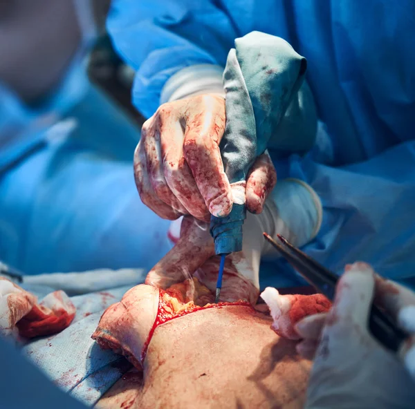Närbild Läkare Händer Handskar Som Utför Magen Tuck Kirurgi Operationssalen — Stockfoto