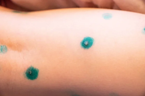 Blisters Rash Chickenpox Skin Treated Covered Brilliant Green Medicine Process — Stock Photo, Image