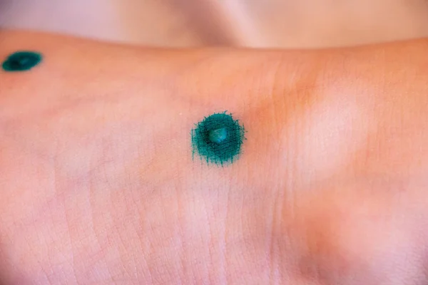 Blisters Rash Chickenpox Skin Treated Covered Brilliant Green Medicine Process — Stock Photo, Image