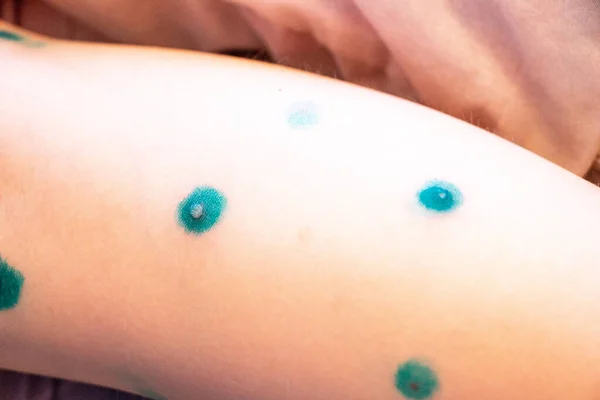 Blisters Rash Chickenpox Skin Treated Covered Brilliant Green Medicine Process — Stock Photo, Image