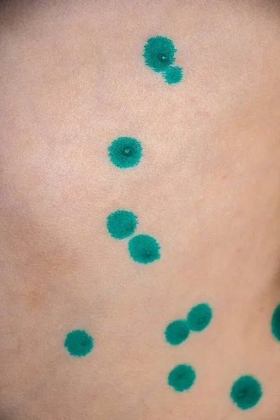 Blisters Rash Chickenpox Skin Treated Covered Brilliant Green Medicine Process — Stock Photo, Image