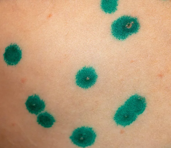 Blisters Rash Chickenpox Skin Treated Covered Brilliant Green Medicine Process — Stock Photo, Image