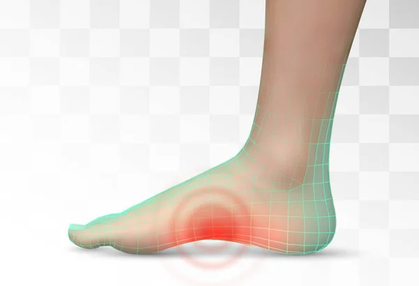病媒人类的脚 疼痛的红斑 医用和矫形外科的预备元件 — 图库矢量图片