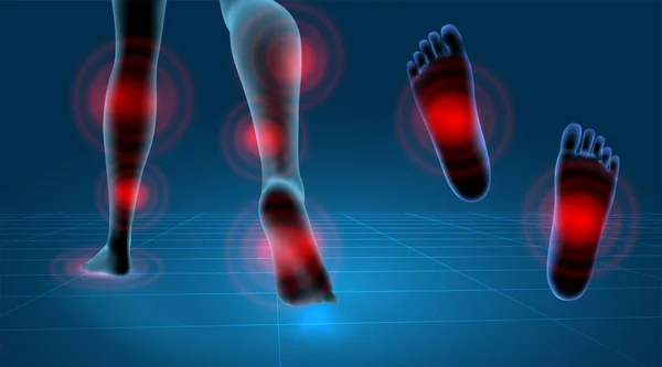 病媒人类的脚 蓝色的轮廓和红色的疼痛点 医用和矫形外科的预备元件 — 图库矢量图片
