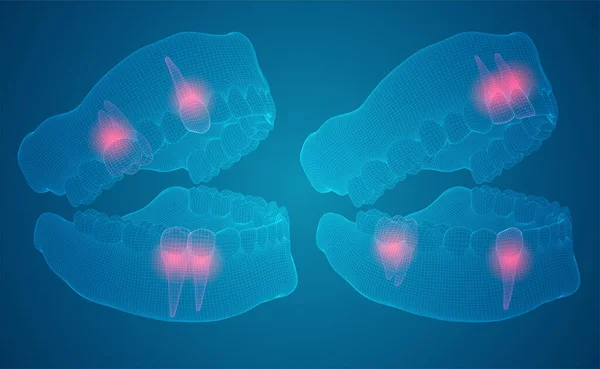 人間の顎 3Dベクトルレイアウト 薬と健康 痛みの歯 — ストックベクタ