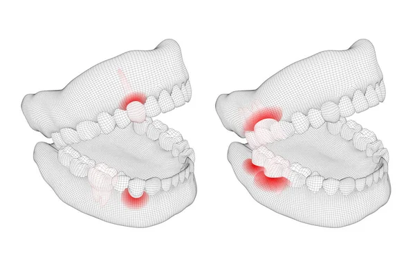 人类的下巴 3D矢量布局 药物与健康 疼痛的牙齿 — 图库矢量图片