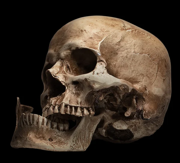 Skull-open mouth, broken jaw — Stock Photo, Image