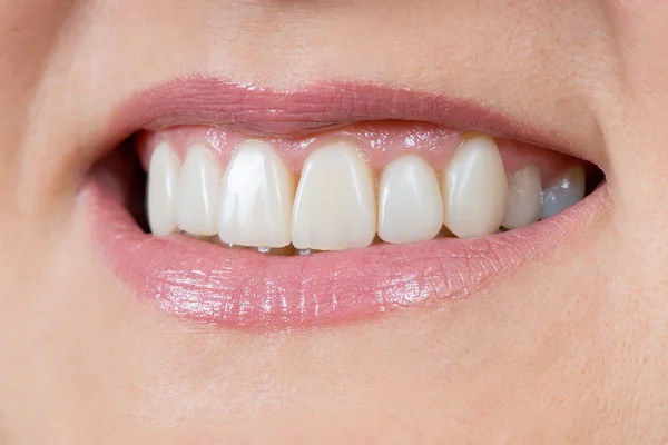 A száj és a felújított fogak közelről — Stock Fotó