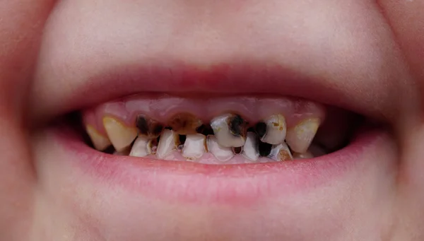 Карієс на зубах дитини — стокове фото