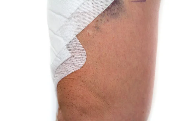 Leg after surgery on white background — Stock Photo, Image