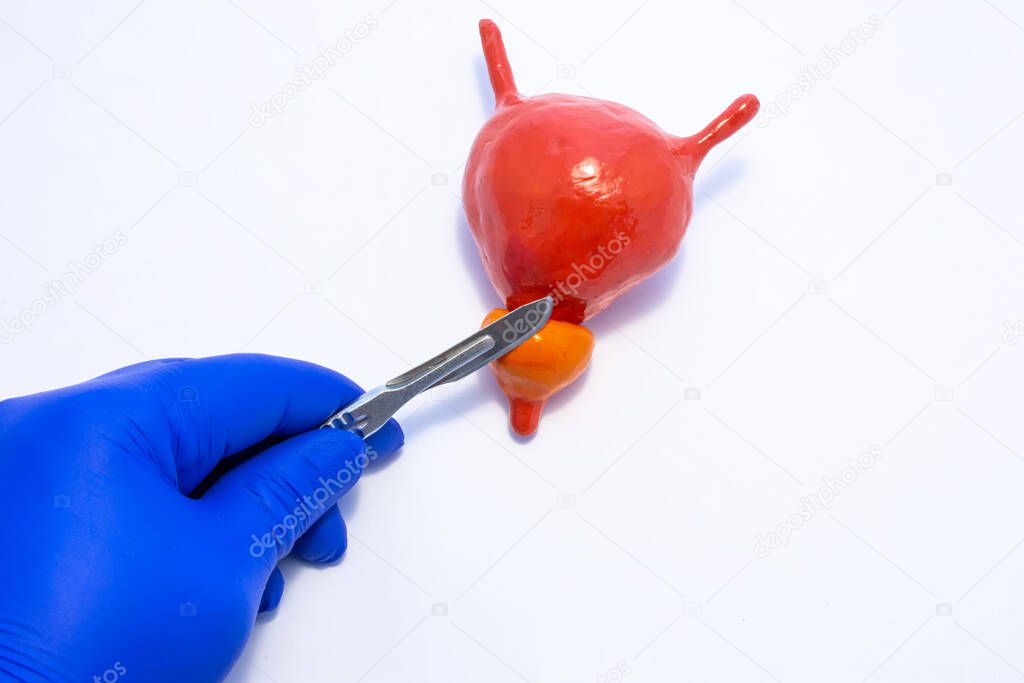 Doctor urologist surgeon holds a scalpel in his hand over the anatomical model of the bladder and prostate. Concept photo of surgical treatment of male genital and urinary organs