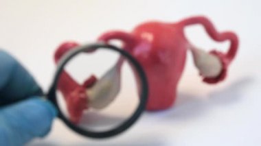 Kadınların cinsel üreme sisteminin teşhisi yumurtalıklar, dölyatağı tüpleri kısırlığa neden olur. Doktorun elinde büyüteç ve optik büyütme ile yumurtalık hastalıkları teşhisi konuldu.