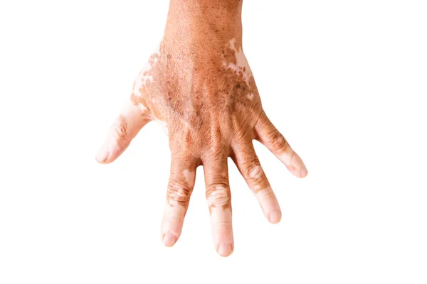 Gros Plan Vitiligo Sur Les Mains Peau Des Personnes Âgées — Photo