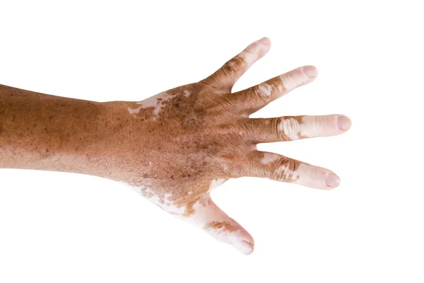 Close Vitiligo Skin Hands Old People Medical Condition Causing Depigmentation — Stock Photo, Image