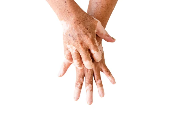 Close Vitiligo Skin Hands Old People Medical Condition Causing Depigmentation — Stock Photo, Image