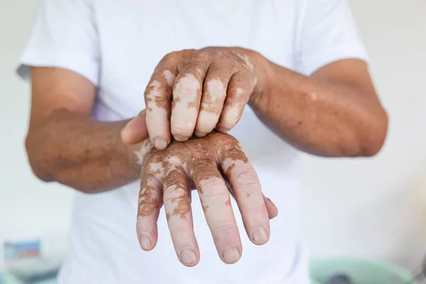 Gros Plan Vitiligo Sur Les Mains Peau Des Personnes Âgées — Photo
