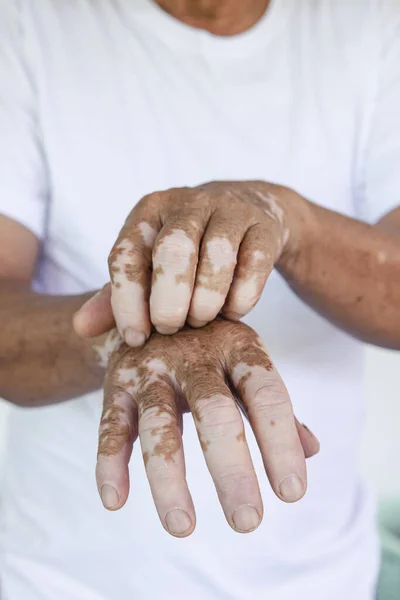 Gros Plan Vitiligo Sur Les Mains Peau Des Personnes Âgées — Photo