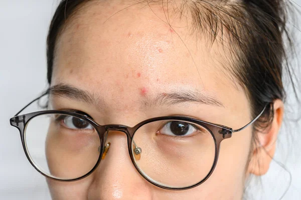 Close-up of woman forehead with the problem of Acne and Scar from acne inflammation (Papule and Pustule) on her forehead. Conceptual of problems on woman skin.