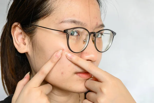 亚洲女人试图挤压脸上痤疮的画像 女性皮肤上痤疮和疤痕的概念照片 — 图库照片