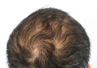 Top view of men's head with thin hair and a hair whorls. Hair whorl is a patch of hair growing in a circular direction around a visible center point. clipart