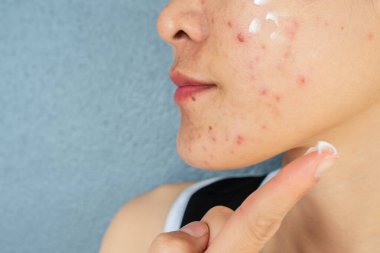Yüzünde sivilce iltihabı (Papule ve Pustule) olan yarım yüzlü bir kadın resmi ve tedavi için yüzüne sivilce kremi sürüyor. Kadın tenindeki sorunların kavramı.