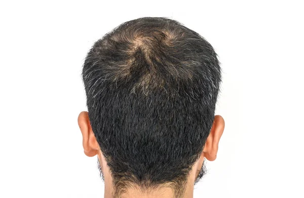 Achteraanzicht Van Mannen Hoofd Met Dun Haar Grijs Haar Groeien — Stockfoto