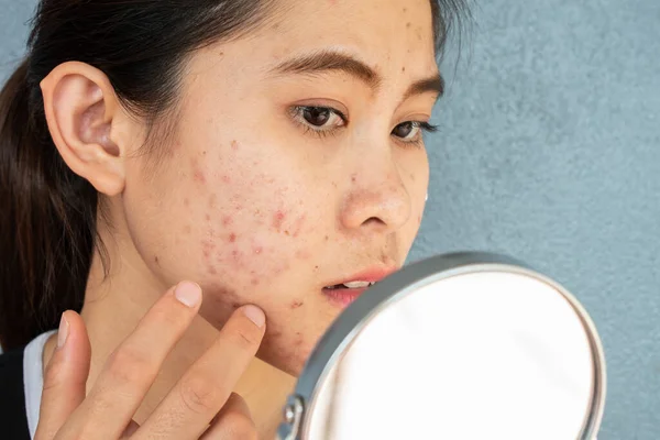 Portrait Asian Woman Worry Her Face She Saw Problem Acne — Stock Photo, Image