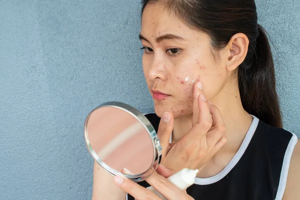 Retrato Mujer Asiática Preocuparse Por Cara Cuando Vio Problema Inflamación — Foto de Stock