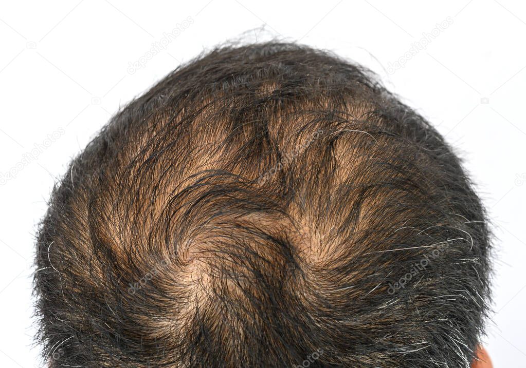 Top view of men's head with thin hair and a hair whorls. Hair whorl is a patch of hair growing in a circular direction around a visible center point.