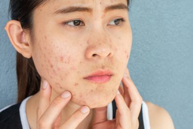 Yüzünde sivilce iltihabı (Papule ve Pustule) olan endişeli kadına yakın durun. Kadın tenindeki sorunların kavramı.