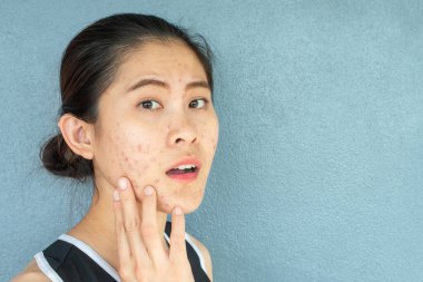 Yüzünde sivilce iltihabı (Papule ve Pustule) sorunu olan endişeli bir kadının portresi ve gri duvarında fotokopi alanı var. Kadın tenindeki sorunların kavramı.