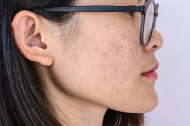 Kadın yüzünün yan görünüşünde akne, sivilce, gözenek ve melasma gibi çeşitli sorunlar vardır. Kadın teninde doğal sorun kavramı.