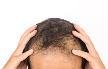 Beyaz fotokopi alanı olan erkek kalıplı kelliğe yakın çekim, genellikle ilk olarak saç çizgisinde ya da kafasının tepesinde görülür. Kısmi veya tam kelliğe kadar ilerleyebilir..