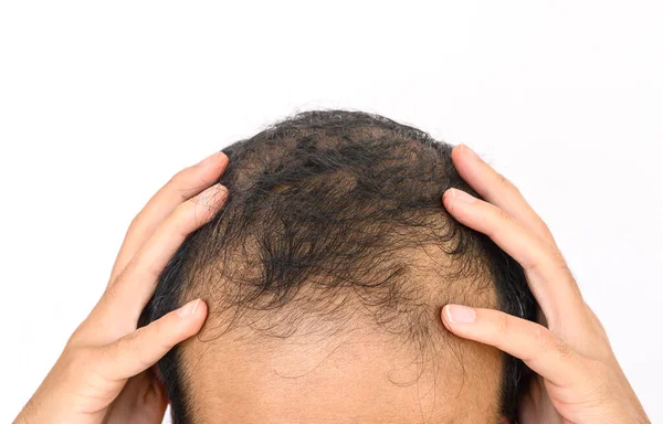 Beyaz fotokopi alanı olan erkek kalıplı kelliğe yakın çekim, genellikle ilk olarak saç çizgisinde ya da kafasının tepesinde görülür. Kısmi veya tam kelliğe kadar ilerleyebilir..