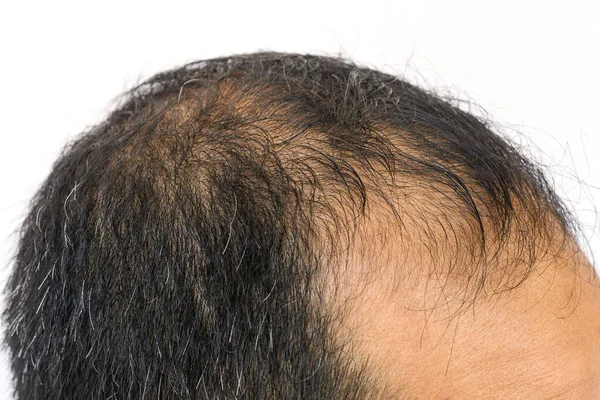 Close Male Pattern Baldness Typically Appears First Hairline Top Head — Stock Photo, Image