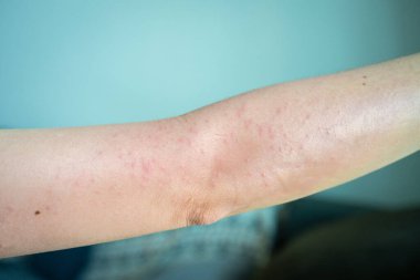 Kızarıklıkların kesikli görüntüsü kadın kolunda meydana gelir. Kollarınızdaki kızarıklık alerjik bir reaksiyon, tahriş edicilerle temas, enfeksiyon ya da sedef hastalığı gibi altta yatan bir hastalığa bağlı olabilir..