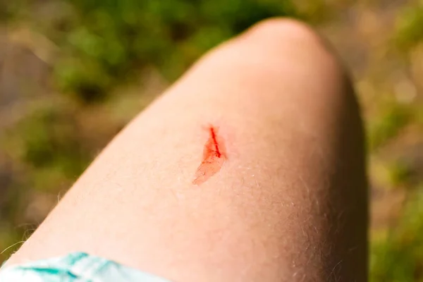Fresh wound on the leg, thigh with blood. Skin texture. Body positive - body hair. Womans leg. The red scratch is bleeding. First aid — Stock Photo, Image
